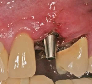 2. Tooth removed and implant placed at same appointment: