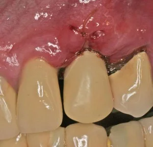 3. Temporary crown placed on implant (same day):