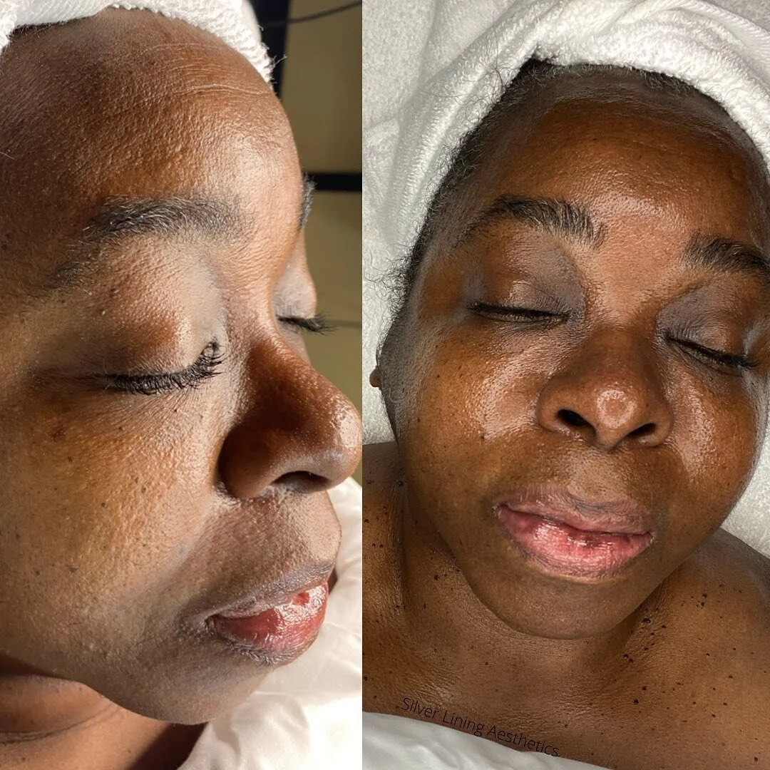 My beautiful client after a diamond microdermabrasion facial. This treatment includes

Diamond Microdermabrasion is a non-invasive procedure that uses diamond tips to exfoliate the surface of the skin, while the power of vacuum suction removes dead s