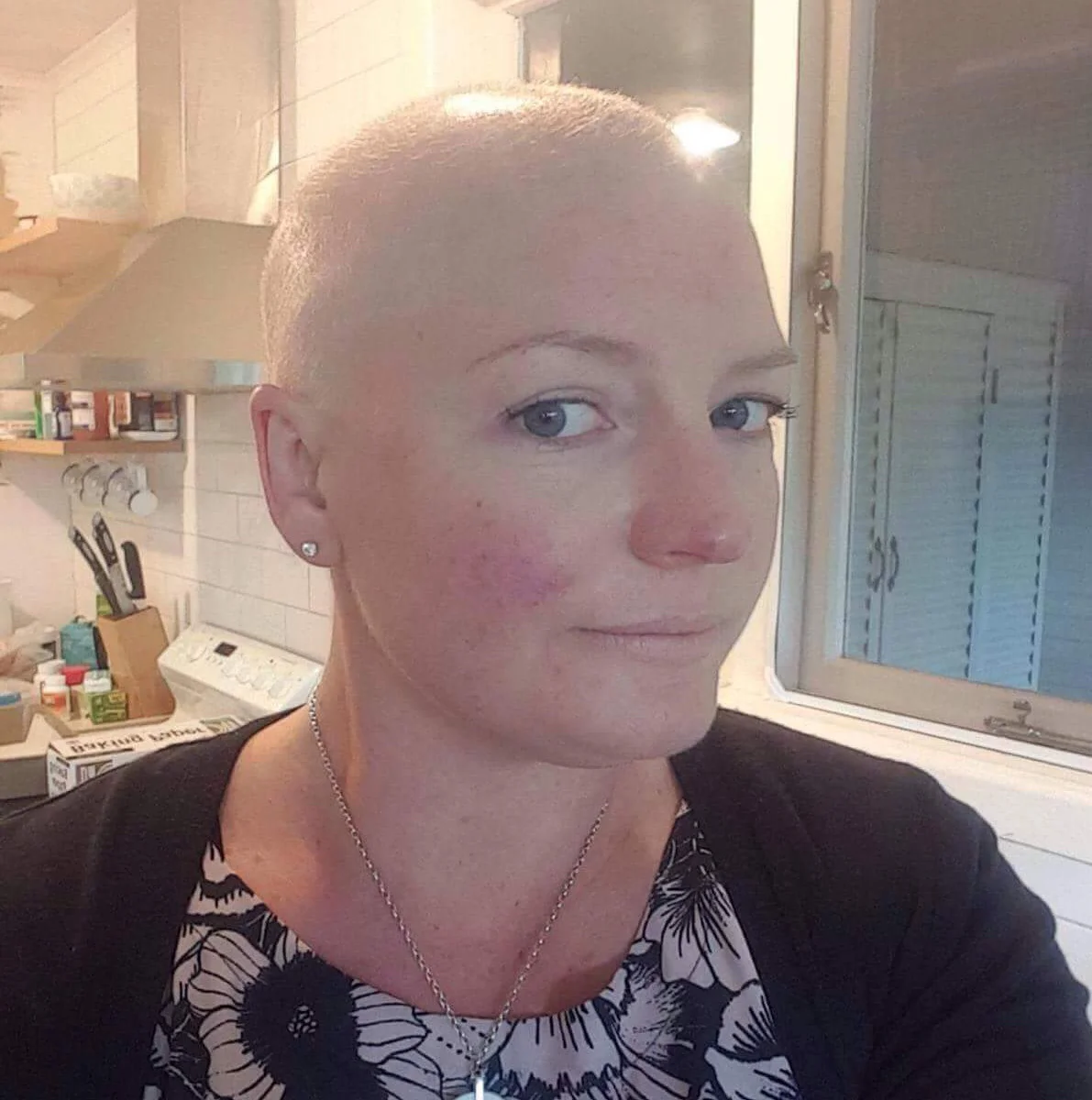 Bald and overweight after 6 months of chemotherapy.jpg