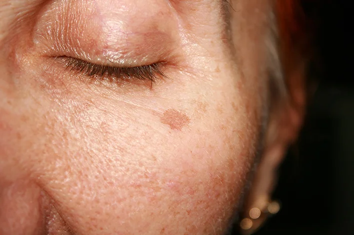 Dermatological symptoms:Skin Pigmentation on the face.