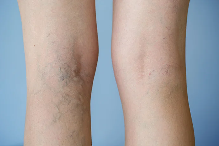 Dermatological symptoms: Leg veins and varicose veins.