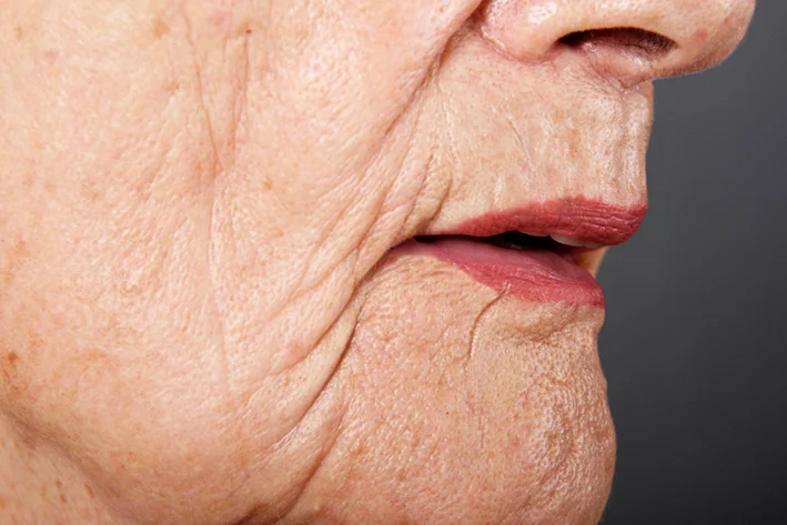 Dermatological symptoms: Sagging Facial Skin.