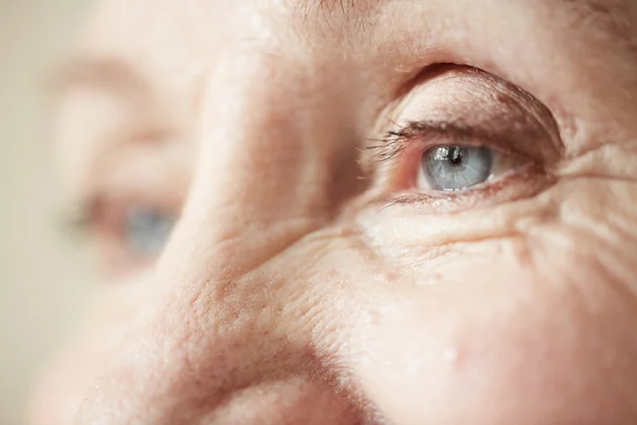 Dermatological symptoms: Fine lines and wrinkles of the skin.