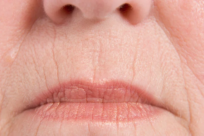 Dermatological symptoms: Low volume of the lips.