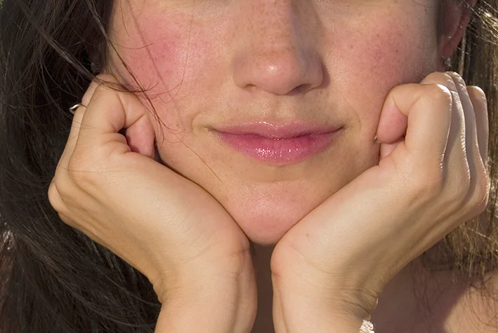 Dermatological symptoms: Skin redness on the face.