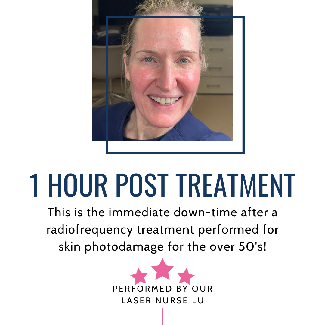 Rejuvenating your skin after 50: Radiofrequency Ablative Treatment