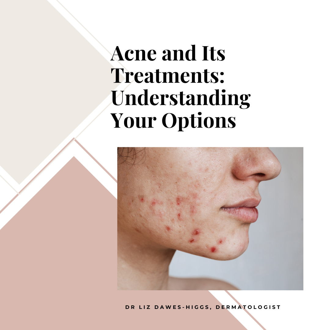 Acne and Its Treatments: Understanding Your Options