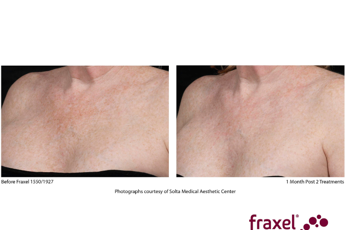 Fraxel BNA for website (10).png