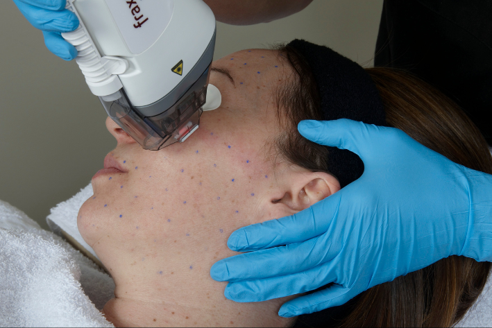 fraxel in action web.png