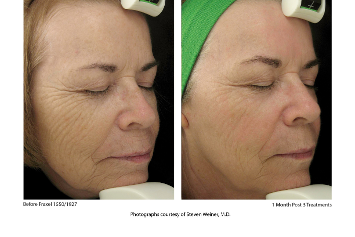 Fraxel dual general bna.png