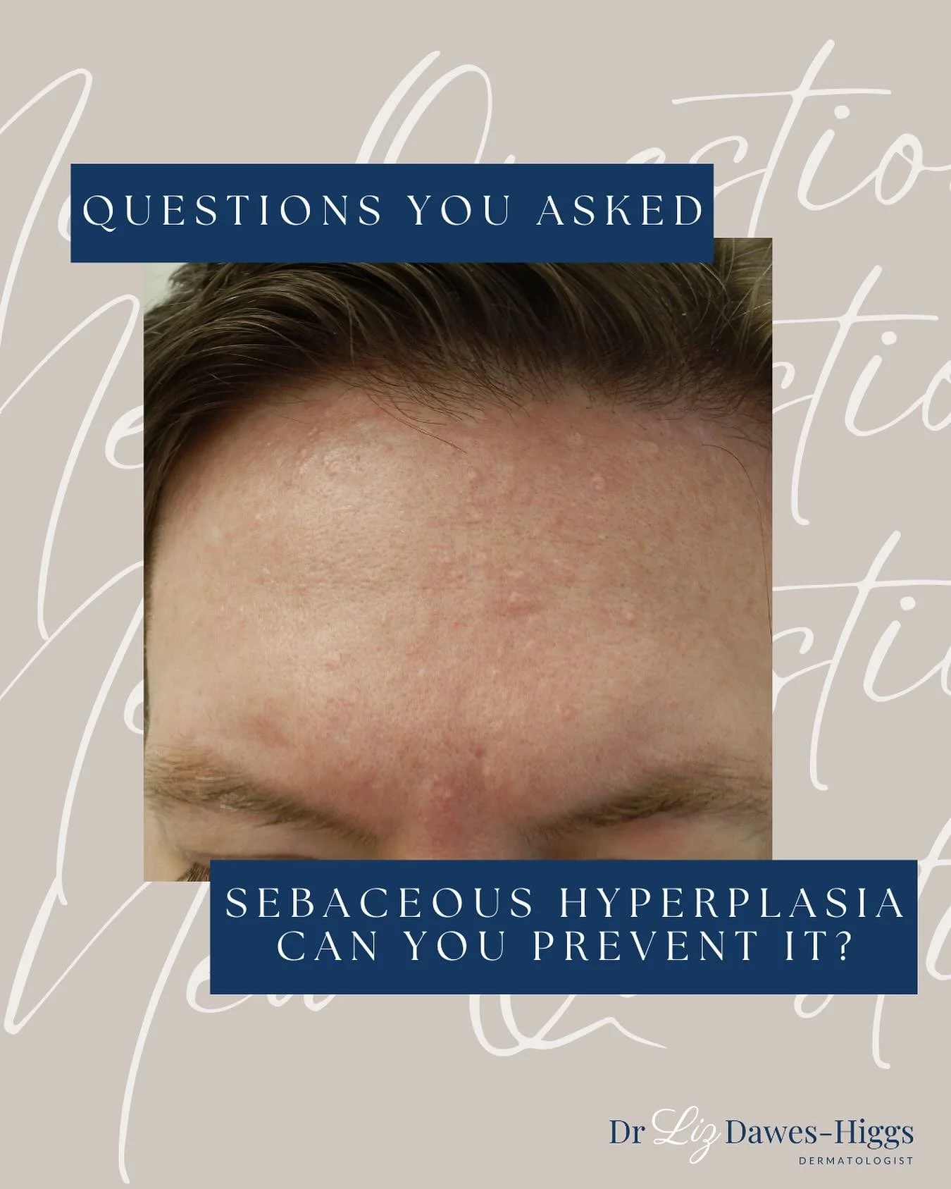 &ldquo;Questions You Asked: Sebaceous Hyperplasia - Can You Prevent It?&rdquo;
 
Sebaceous hyperplasia = benign overgrowth of oil glands and they are common with age, hormones, and sun exposure.

Can we prevent it? 
There&rsquo;s no proven method to 