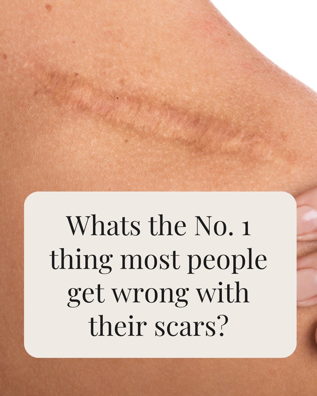 What is the most common mistake people make with scars?

They stretch them - usually without realising. Tension or movement across a healing scar can make it wider or more noticeable over time.

What actually helps scars heal well?
&bull; Gentle pres