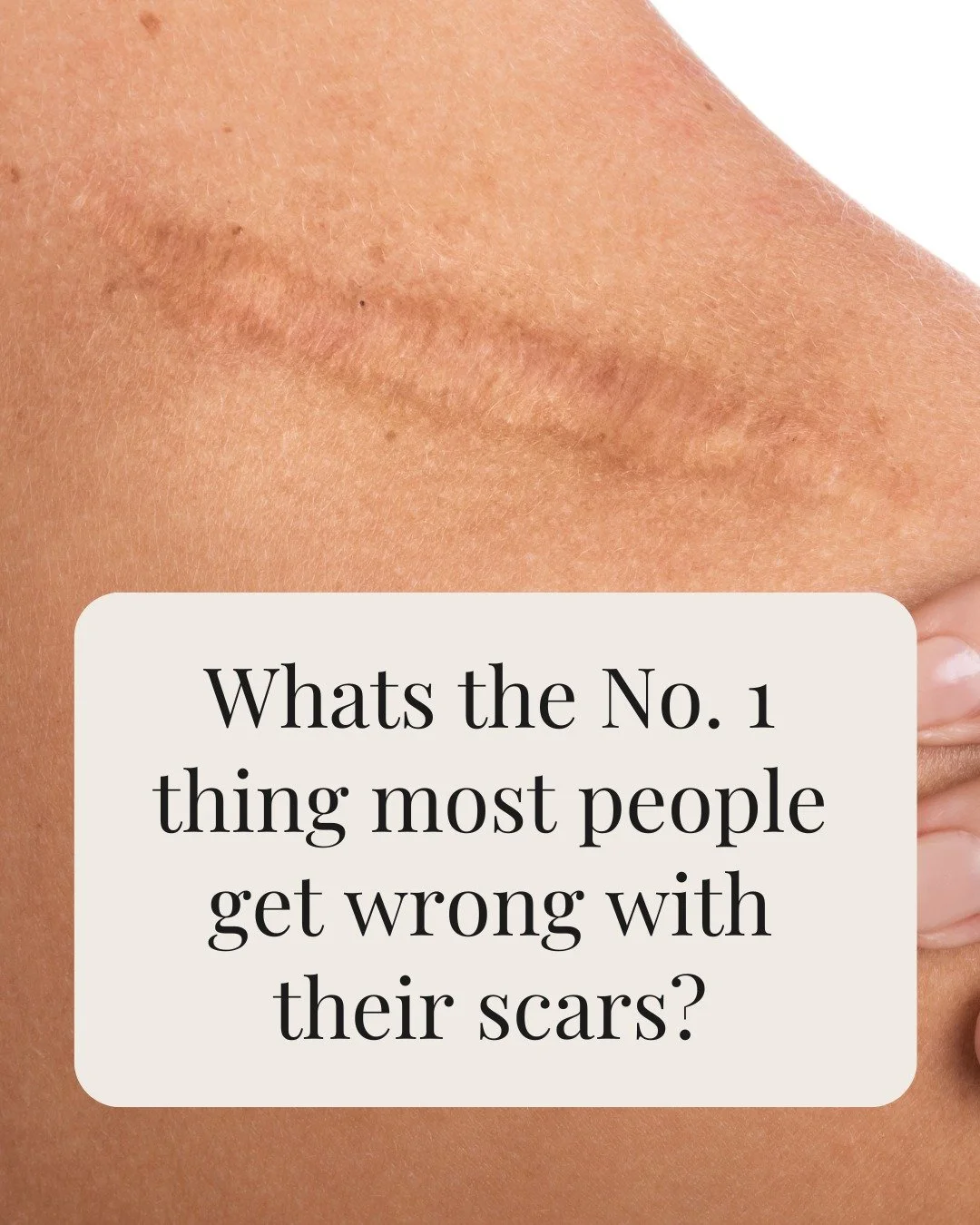 What is the most common mistake people make with scars?

They stretch them - usually without realising. Tension or movement across a healing scar can make it wider or more noticeable over time.

What actually helps scars heal well?
&bull; Gentle pres