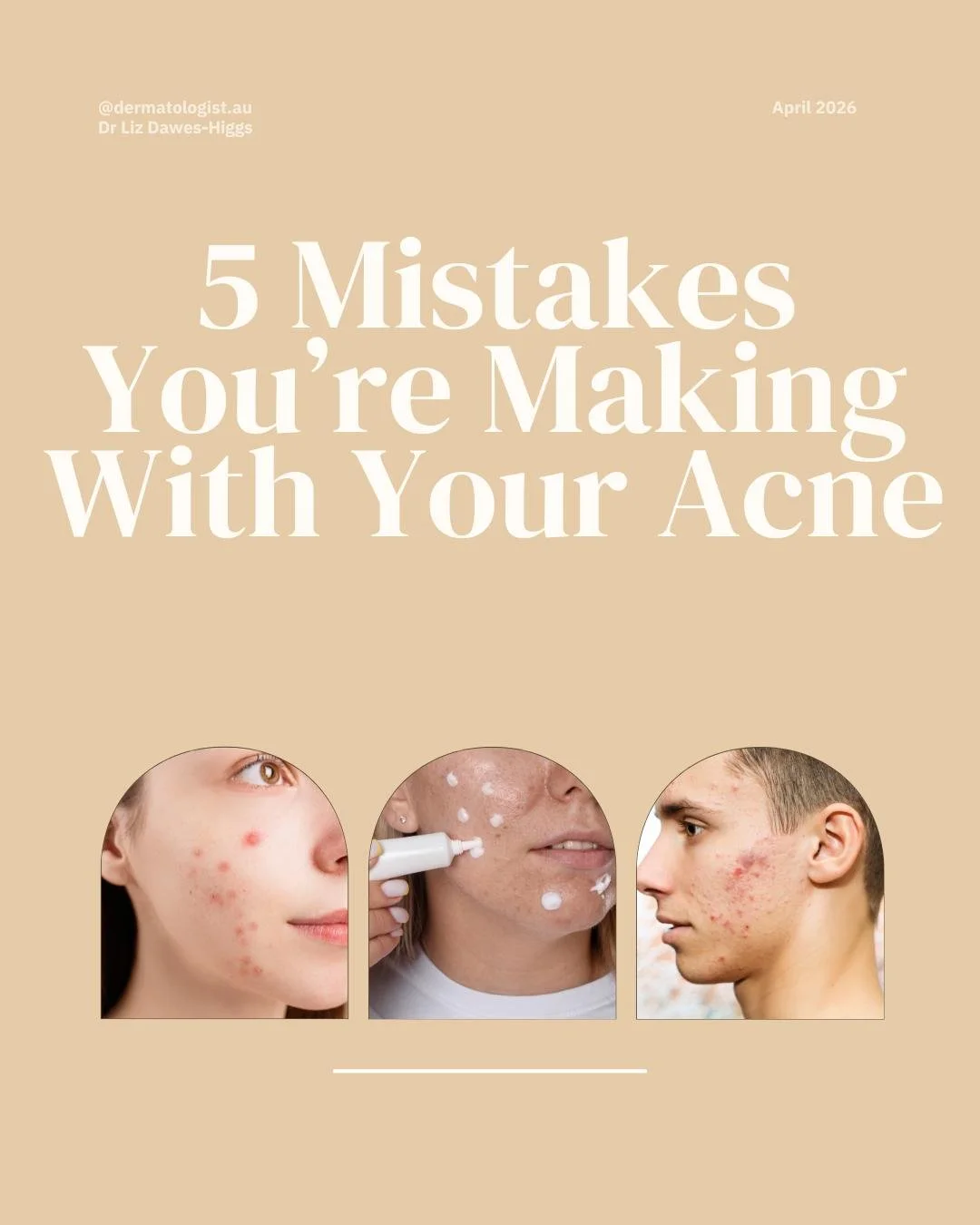 5 Mistakes you Might be Making with Your Acne.

You're doing everything "right" but your skin still isn't clear. Here's why&hellip;..
Most people don't realise that acne has 4 separate drivers and treating only 1 of these doesn&rsquo;t nece
