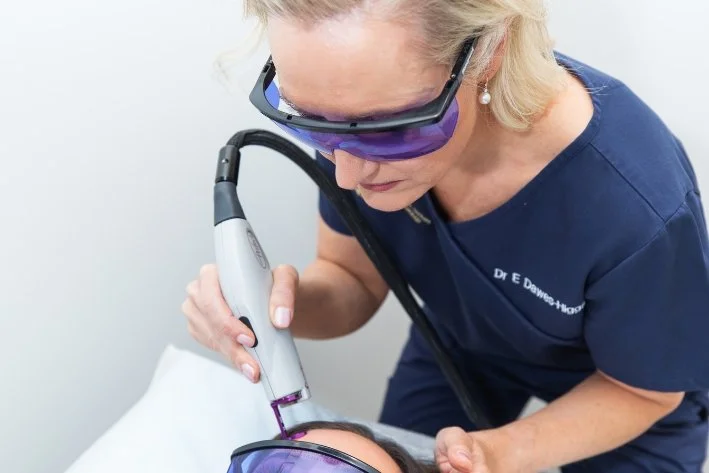 V-Beam Perfecta Laser Treatment for Facial Redness & Vascular Concerns in Sydney