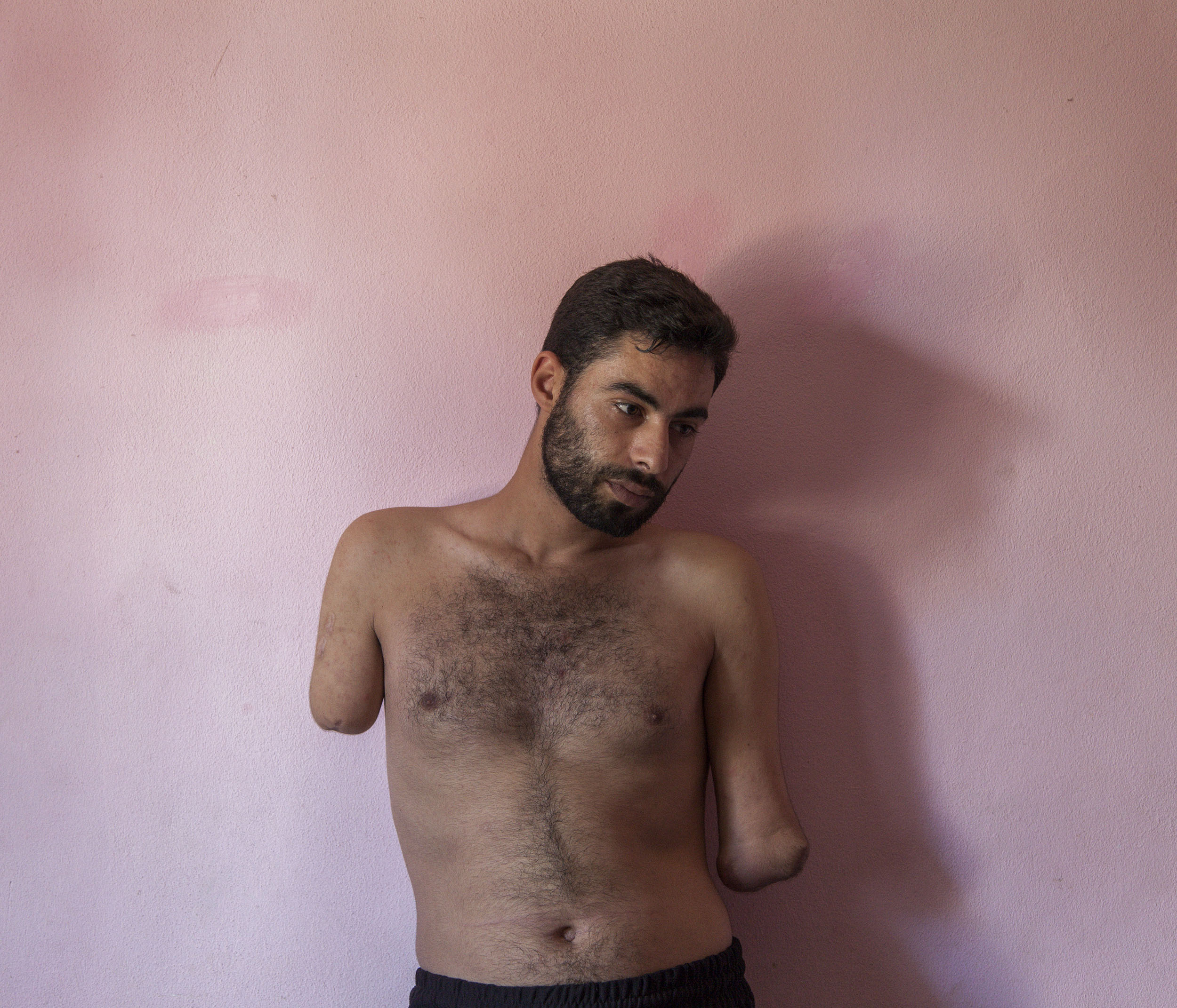  Mohammed (22) was injured in March 2013 when his family home in Qousyr, Syria was hit by government shelling. His uncle was killed and many of his family were injured in the same incident. He was living as a refugee with his wife and young child in 