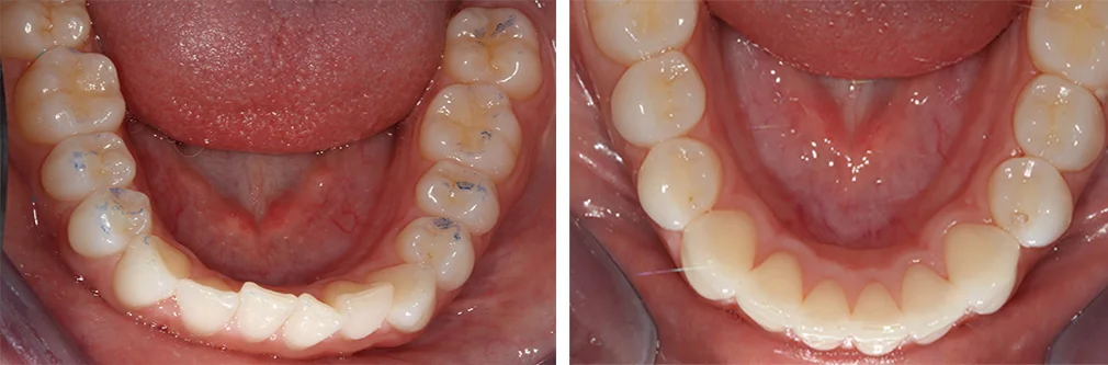 invisalign hill country, invisalign Austin