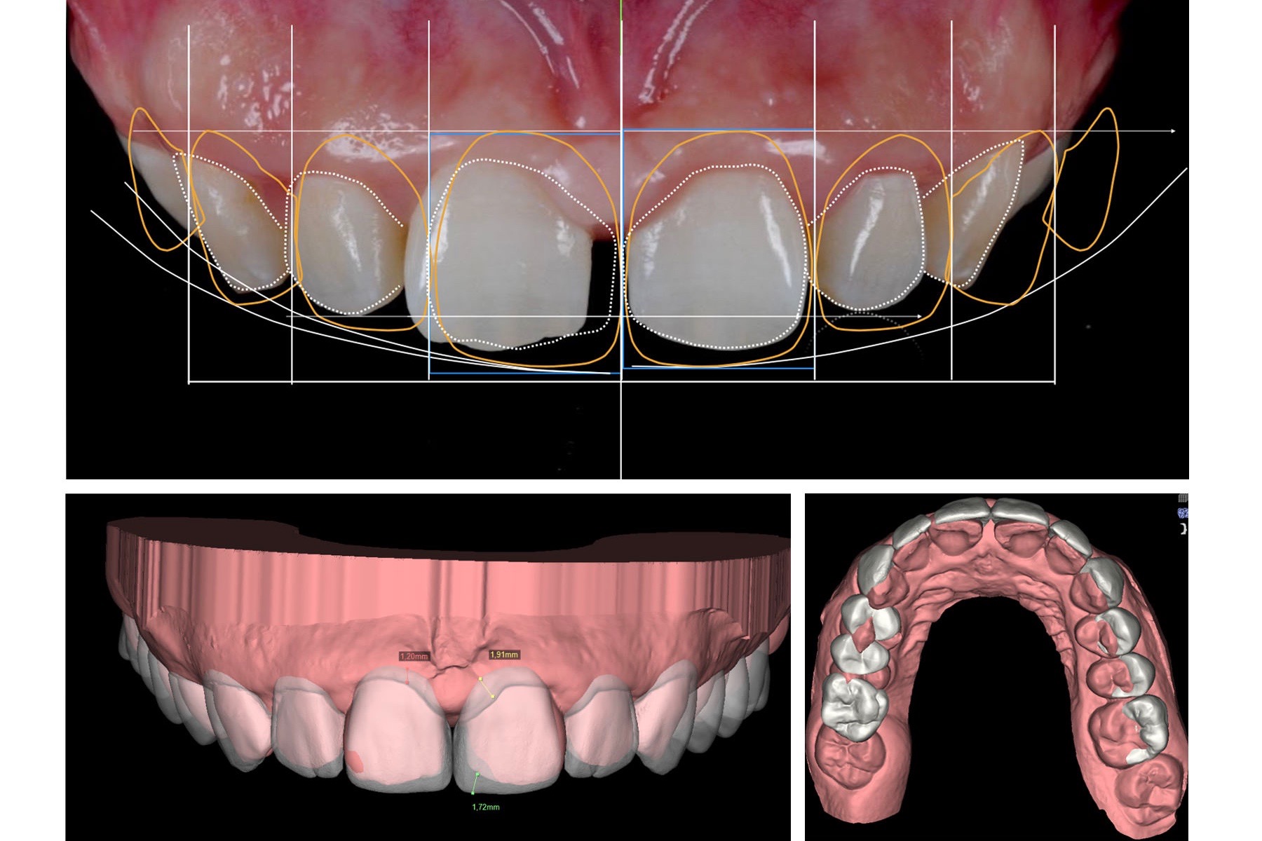 digital smile design, DSD dental