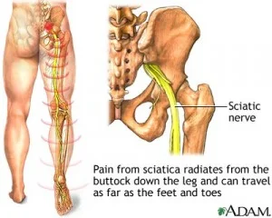 sciaticasymptoms1-300x240.jpg