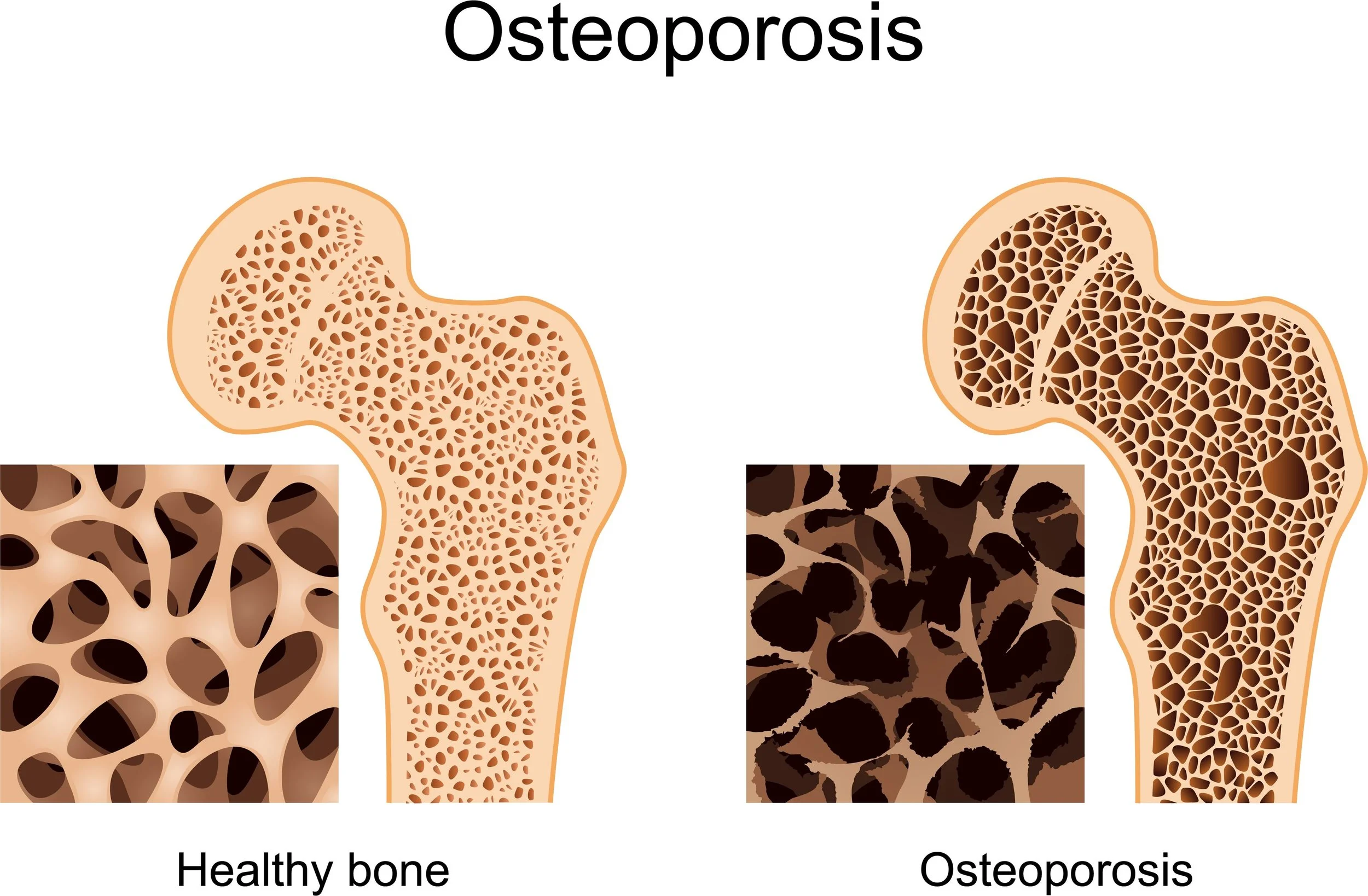 Good Bone Health and Osteoporosis