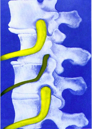 Low Back Pain and Nutrition: The Hidden Connection