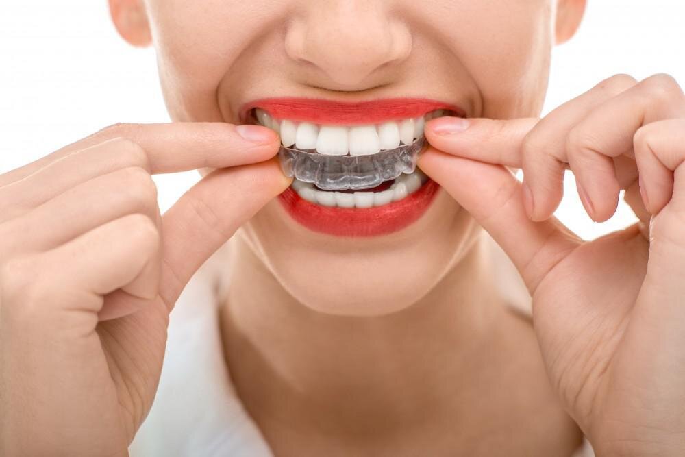 invisalign picture.jpg