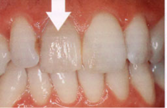 Blij tellen Onnauwkeurig Facings: Je tanden laten slijpen – Tandartspraktijk Zuidoost