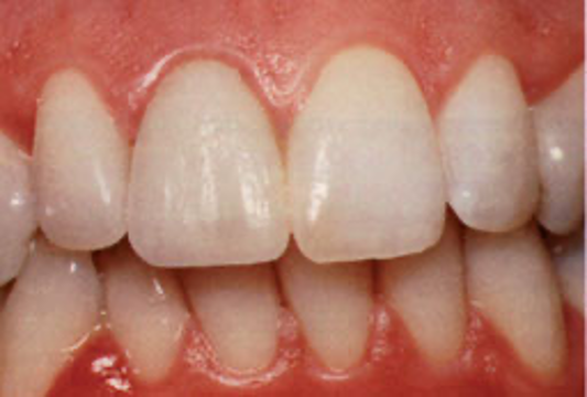 Blij tellen Onnauwkeurig Facings: Je tanden laten slijpen – Tandartspraktijk Zuidoost