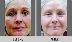 Omni Technology Facial