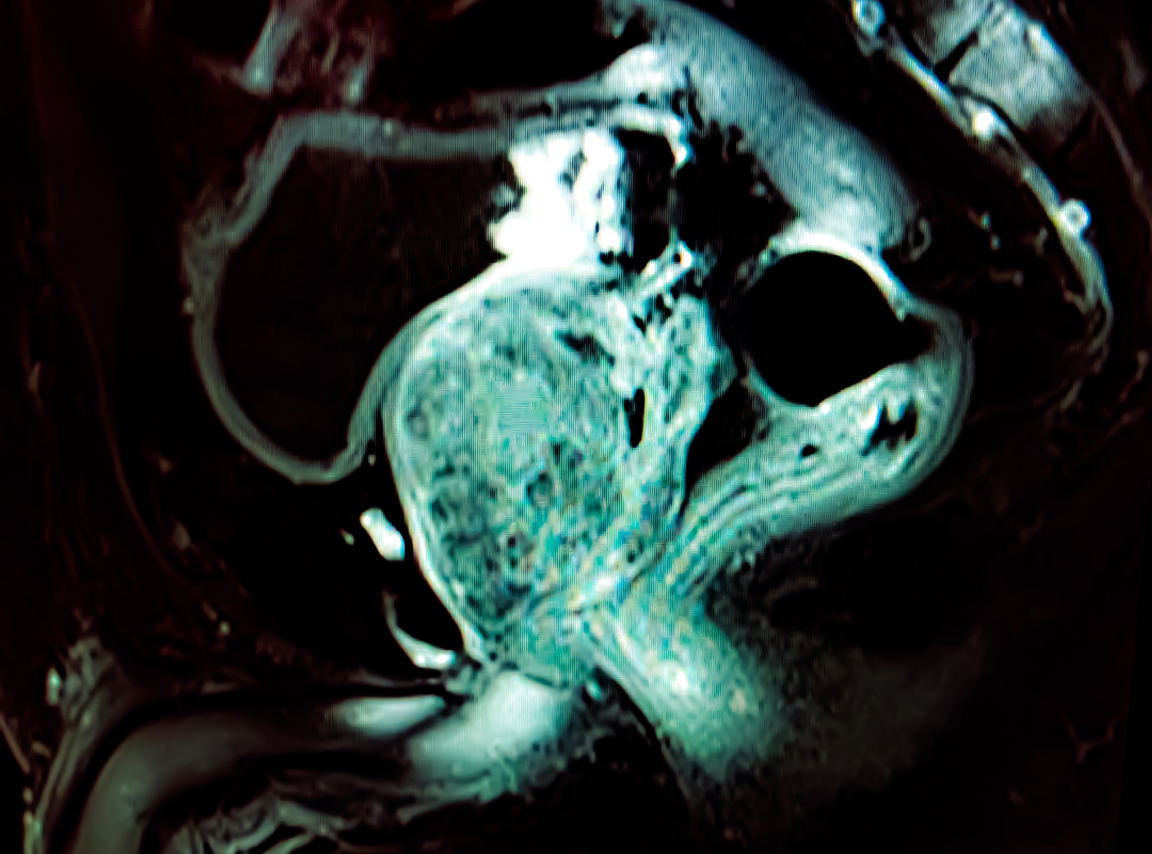 Breakthrough Study in Image-Guided Prostate Cancer Treatment