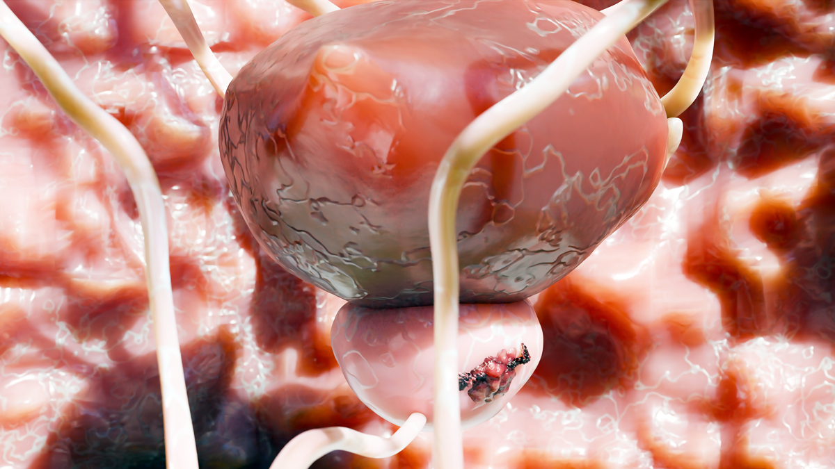 New Prostate Cancer Treatment Approach Slows Progression Without Hurting Quality of Life, Study Finds