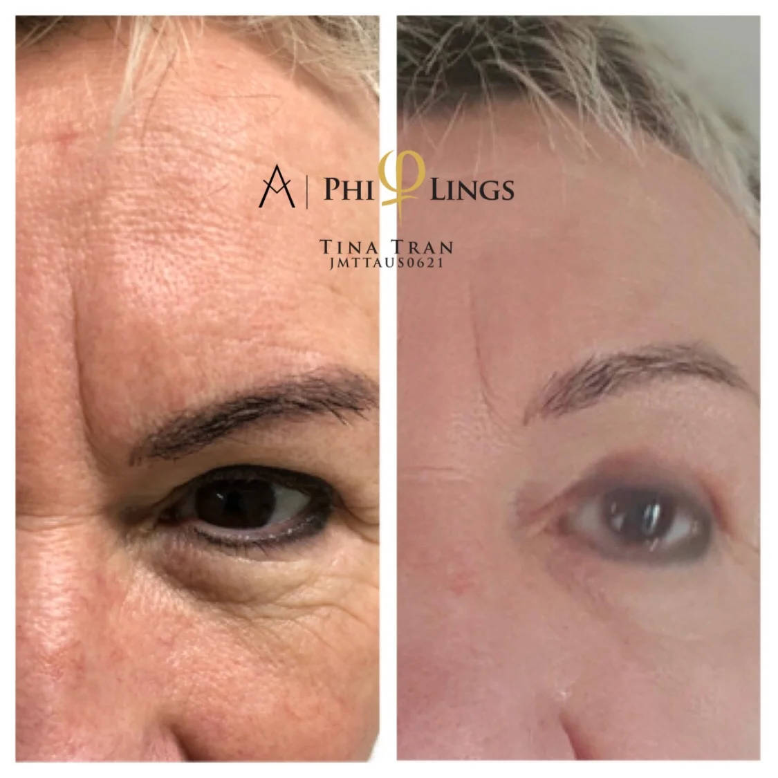 plasma lift eyelift.JPEG