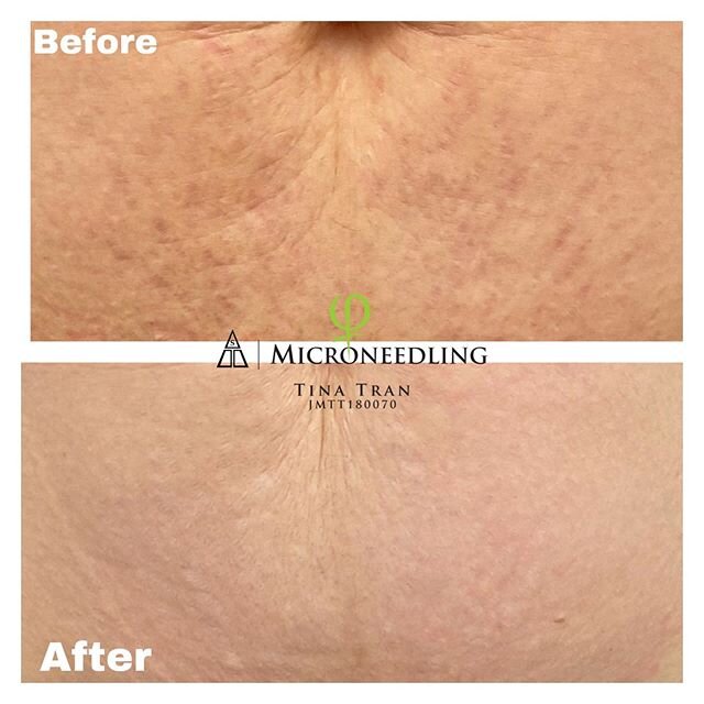 Mummy tummy.  Sick of looking at the stretch marks after birth ? We can help to soften and remove them with our micro needling and patented serum . 
We are now taking appointments from mid June for this special treatment.  Limited appointments availa