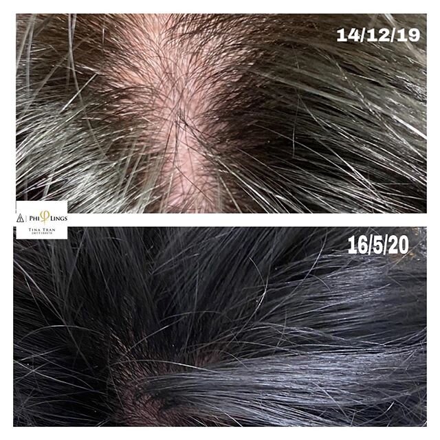Hair growth treatment.  Result - result - result . We are now taking appointments for micro needling with our patented serum from 16th June . 
#philingsofficial #philingsaustralia #tcosmeticsstudio #philingsmaster #philingstraining #philingsroyalarti