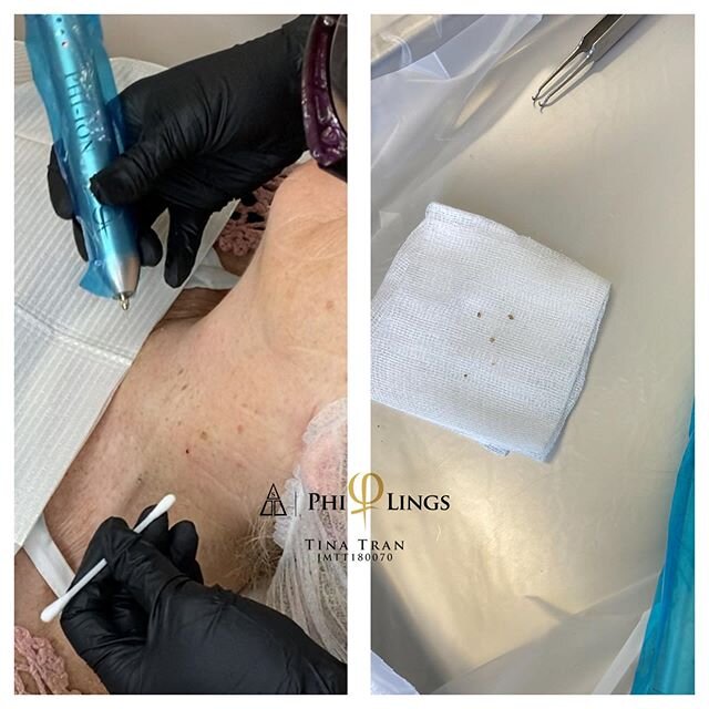 Not happy with skin tag? (Non cancerous growth). Please check with your skin Doctor before contacting us. We can remove them 
#skintagremoval #skintags #noncancerous #philingsofficial #philings #philingsartist #philingsroyalartist #phiacademy #phiacd