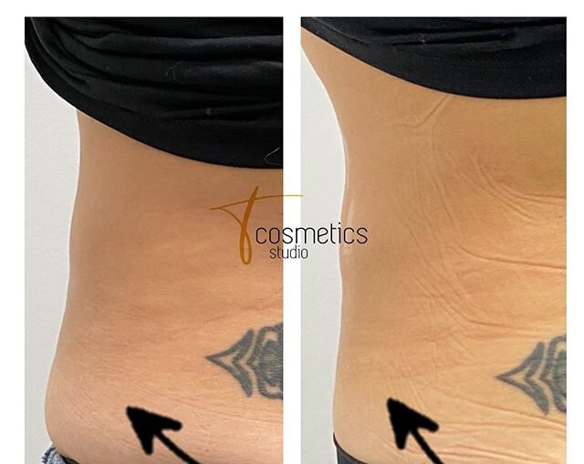 Hello lovelies , 
Who has developed love handles during the pandemic? Have you tried everything at your home gym but the stubborn fat is still there ? We can help you to get that sexy body back with our fat freezing and fat cav 
The results can be se
