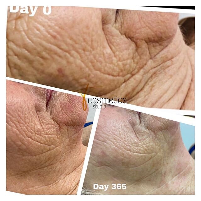 Sometimes you forgot how you look like before the procedure? 
Can you see the difference ? Result can be seen immediately after the treatment but for best results you will need to wait . 
To get that youthful look back, please contact me.  Appointmen