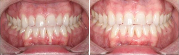 This otherwise healthy 43 year old male patient from Lehi, Utah presented with his lower front tooth in dire need of a gum graft. His main desire was to have the exposed root surface covered as this tooth was extremely sensitive to cold food and drink. When root coverage is required or desired the best treatment option is a Connective Tissue graft.