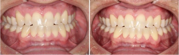 A 39 year old healthy male from Pleasant Grove, Utah presented with localized recession on his upper eye teeth (canines) that is sensitive and unsightly for him. The recession was treated with connective tissue grafting which resulted in complete coverage of his exposed root surfaces.