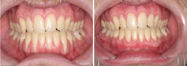 This 27 year old male from Price, Utah has a history of being pretty aggressive with his brushing. The results seen below are only possible through Connective Tissue Grafting. While there are several grafting techniques and substitute materials available today, Connective Tissue remains the "Gold Standard".