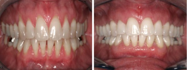This 42 year-old female from South Jordan, Utah presents with the complaint of "sensitive" roots and "spaces" opening up between her teeth. Furthermore, she is concerned about the longevity of her teeth. The results of her grafting should provide her with improved comfort and years of tooth preservation.