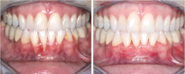 This 36 year-old female from Roosevelt, Utah presents with gum recession on her lower front tooth which is resulting in dental hypersensitivity. She reports that drinking and eating are becoming an "uncomfortable challenge". Her before and after photographs reveal the result of her grafting procedure four weeks after treatment. AWESOME!