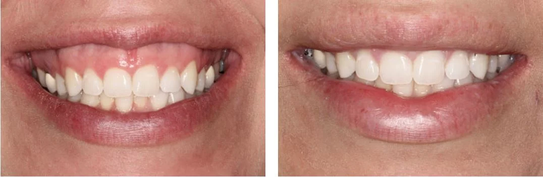  This 27 year old female presented to our office with the chief complaint that she did not like her "gummy smile". She reports that she has been bothered by the excessive amount of gum tissue her whole life. She indicates that she is pleased with the