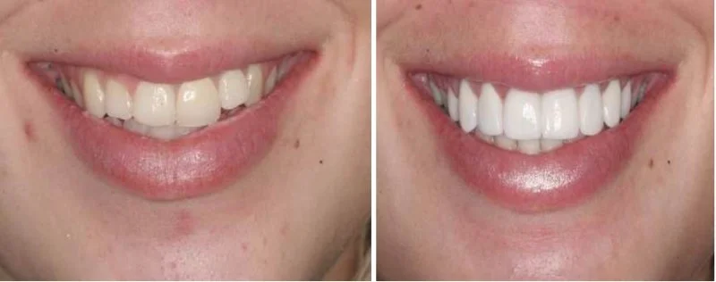  This 23 year old female presents with two complaints regarding her smile.&nbsp; She is unhappy with the appearance of her front tooth that was previously restored with a porcelain fused to metal restoration.&nbsp; She feels like her smile is unbalan