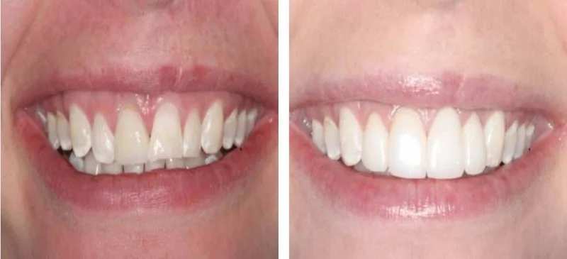  This 27 year old School Teacher wants a new smile!&nbsp; She presents with several challenges.&nbsp; She has chipped teeth, exposed tooth roots, worn teeth etc.&nbsp; However, by doing what is known as "esthetic crown lengthening"&nbsp; we were able