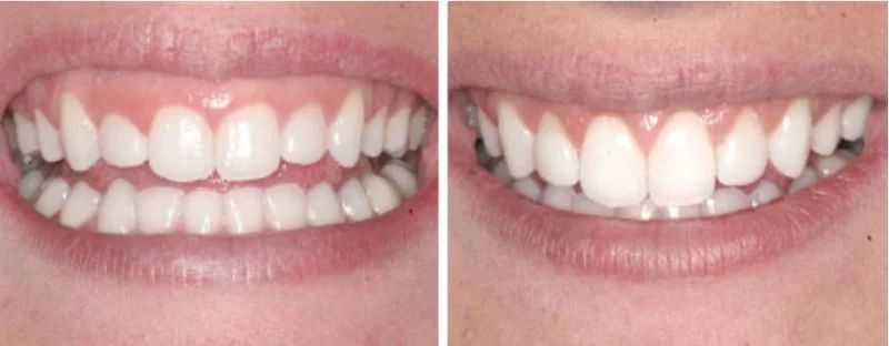  This 20 year-old dental assistant from Orem, Utah is around beautiful smiles everyday and desires to have one for herself. She is aware that in order to improve upon the appearance of her smile (which by the way she has already had porcelain veneers