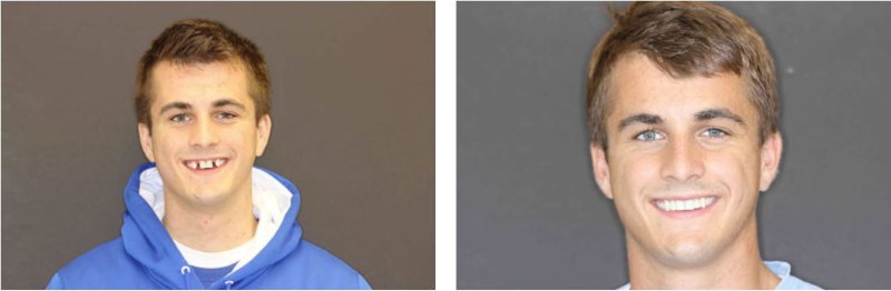  This otherwise healthy, active 21 year old male presented to our office missing both maxillary lateral incisors. His treatment objectives included; replacement of his missing teeth without having to compromise the adjacent teeth by grinding them don