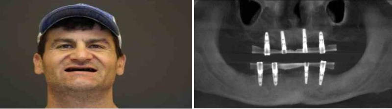  This otherwise healthy, active 44 year old male presented to our office with the desire to replace his missing teeth with dental implants.&nbsp; His dental history revealed that he lost his natural teeth to periodontal disease.&nbsp; He has been wea