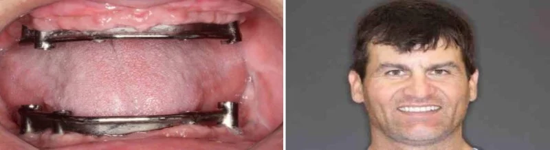  ... continued.&nbsp;Upon gathering our clinical and radiographic examination, including a three dimensional CAT scan, we concluded that he had adequate bone for the placement of dental implants.&nbsp; Taking into consideration that he lost his natur